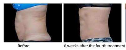 HIFEM Body Sculpting Results at MPi Clinic