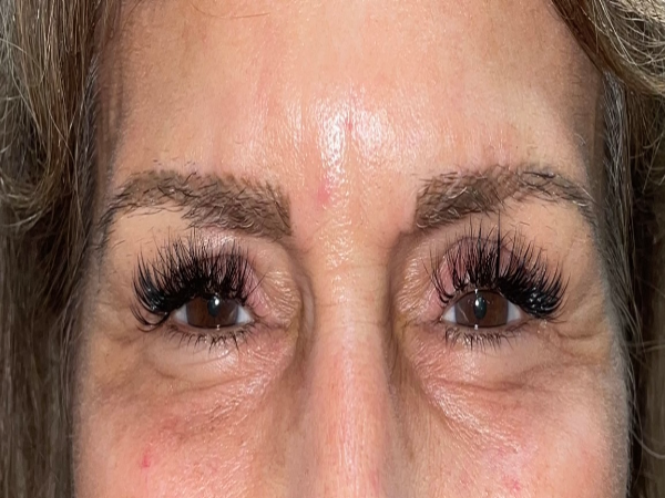 After Photo of Cosmetic Treatment at MPi Clinic San Diego