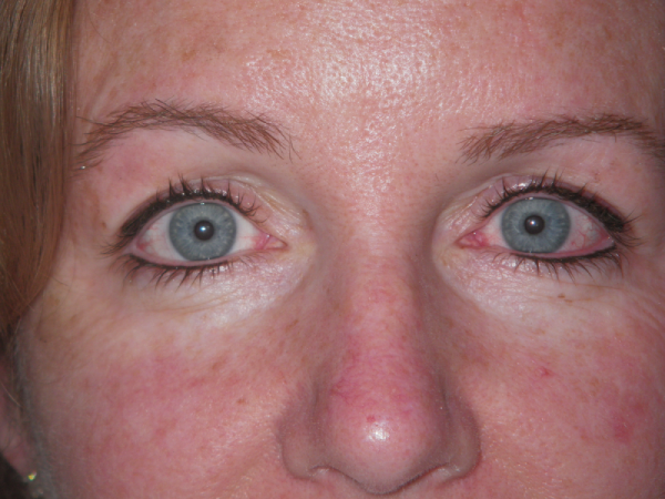 After Photo of Eyeliner Treatment at MPi Clinic San Diego