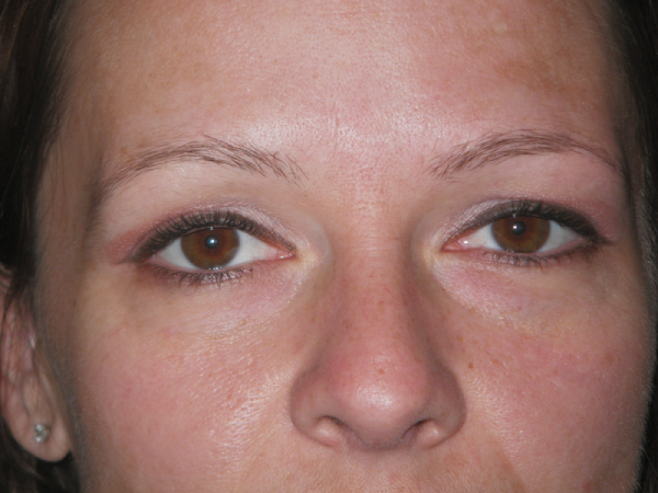 Before Photo of Cosmetic Treatment at MPi Clinic San Diego