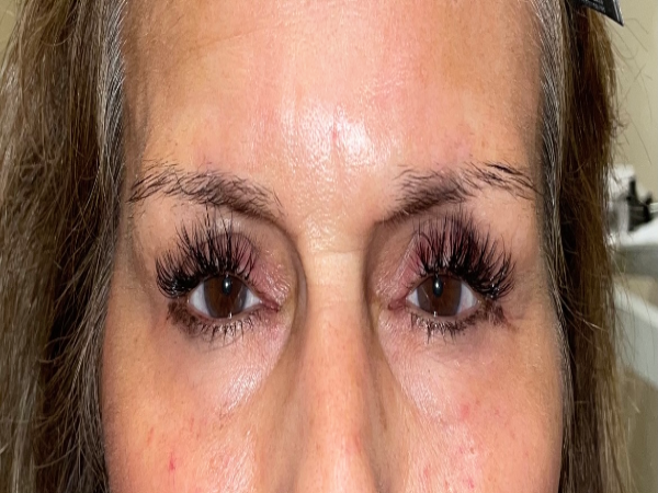 Before Photo of Cosmetic Treatment at MPi Clinic San Diego