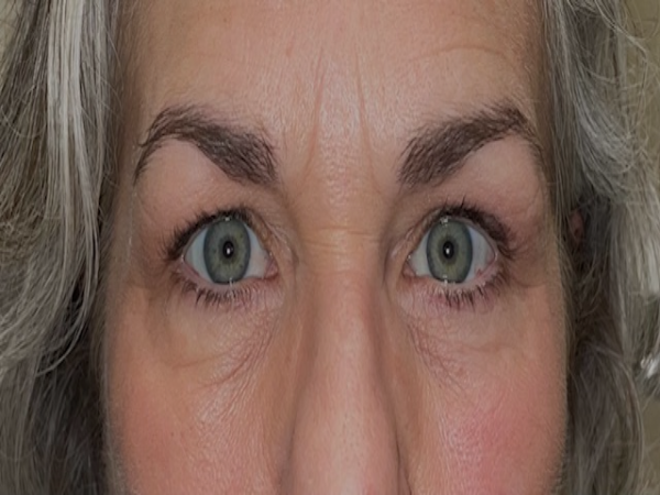 Before Photo of Eyeliner Treatment at MPi Clinic San Diego