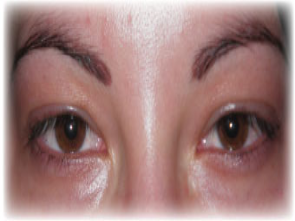 Before Photo of Eyeliner Treatment at MPi Clinic San Diego