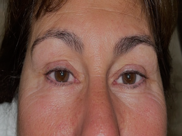 Before Photo of Eyeliner Treatment at MPi Clinic San Diego