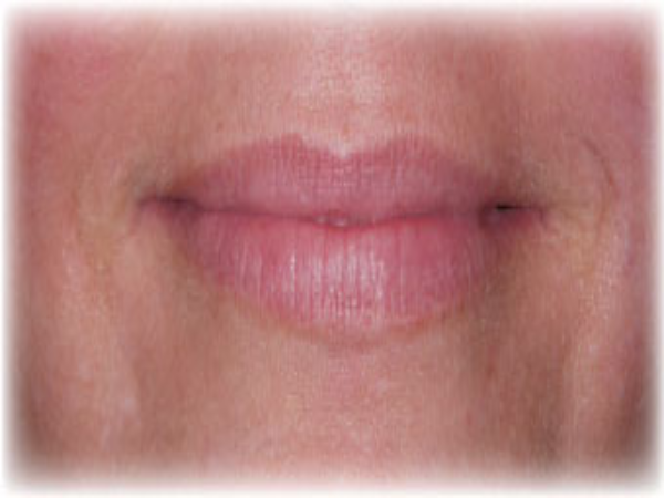 Before Photo of Lip Treatment at MPi Clinic San Diego