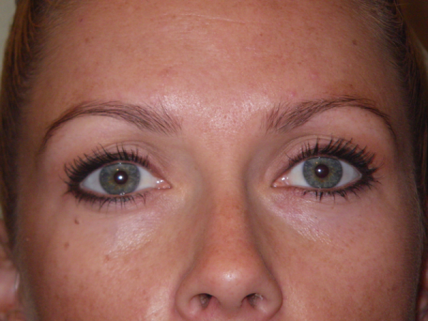 Before Photo of Eyebrow Treatment at MPi Clinic San Diego