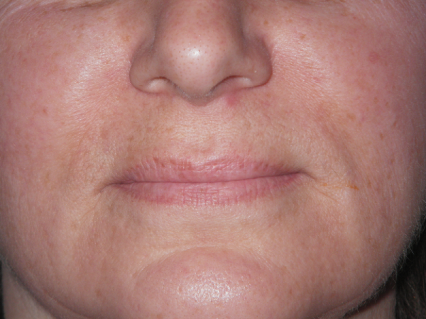 Before Photo of Lip Treatment at MPi Clinic San Diego