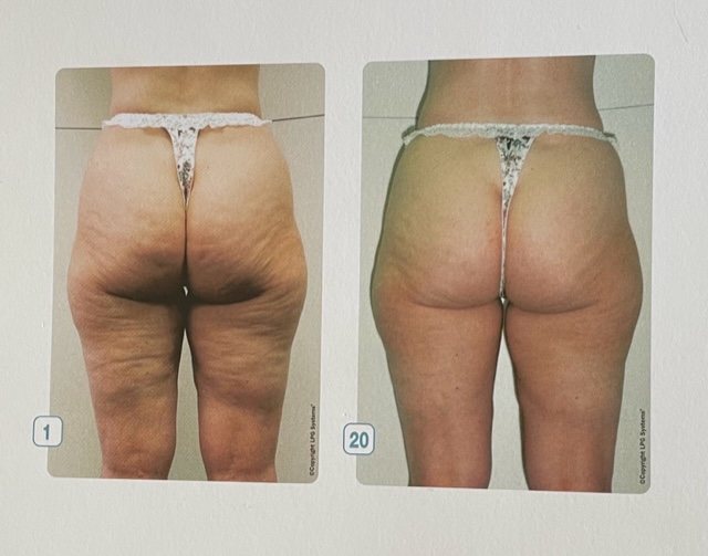 Endermologie Cellulite Reduction Procedure at MPi Clinic San Diego