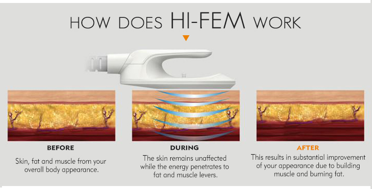 HIFEM Body Sculpting Treatment at MPi Clinic