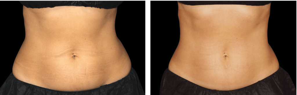 HIFEM Body Sculpting Treatment Results at MPi Clinic