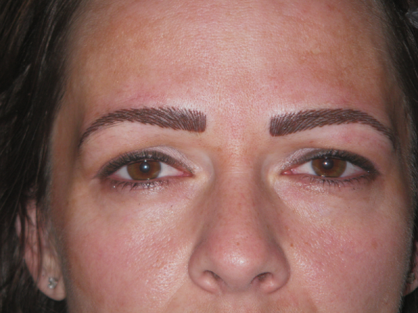 After Photo of Cosmetic Treatment at MPi Clinic San Diego