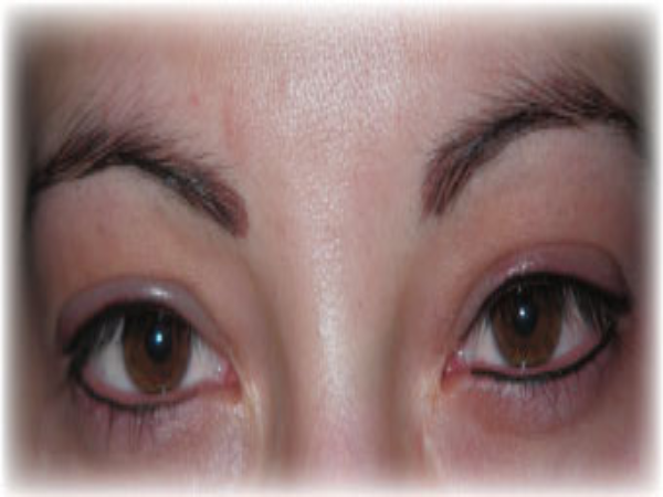 After Photo of Eyeliner Treatment at MPi Clinic San Diego