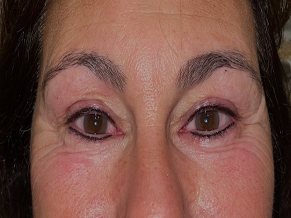 After Photo of Eyeliner Treatment at MPi Clinic San Diego