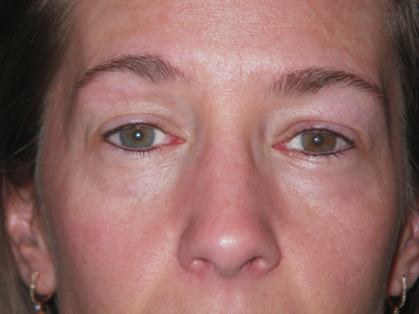 After Photo of Eyeliner Treatment at MPi Clinic San Diego