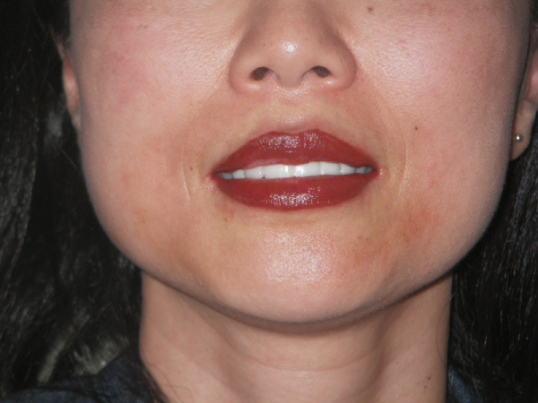 After Photo of Lip Treatment at MPi Clinic San Diego