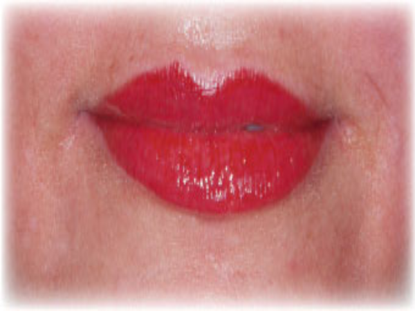 After Photo of Lip Treatment at MPi Clinic San Diego