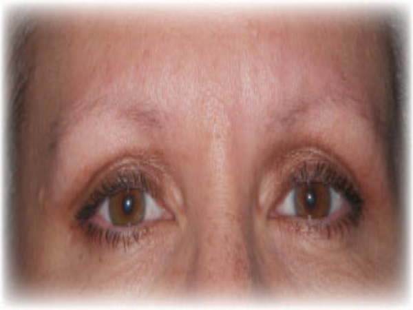 Before Photo of Cosmetic Procedure at MPi Clinic San Diego