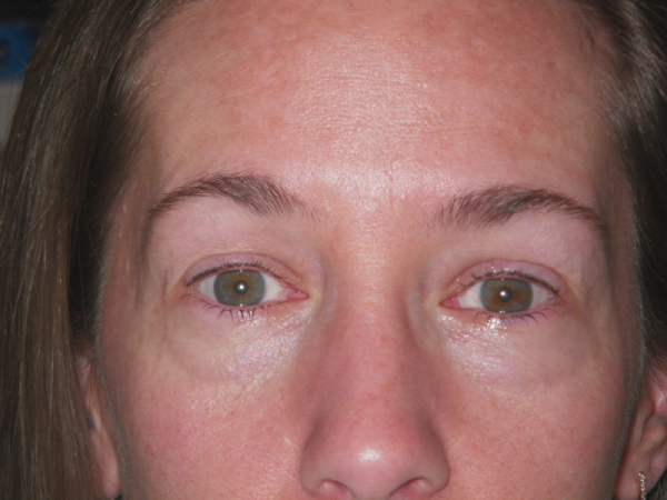 Before Photo of Eyeliner Treatment at MPi Clinic San Diego