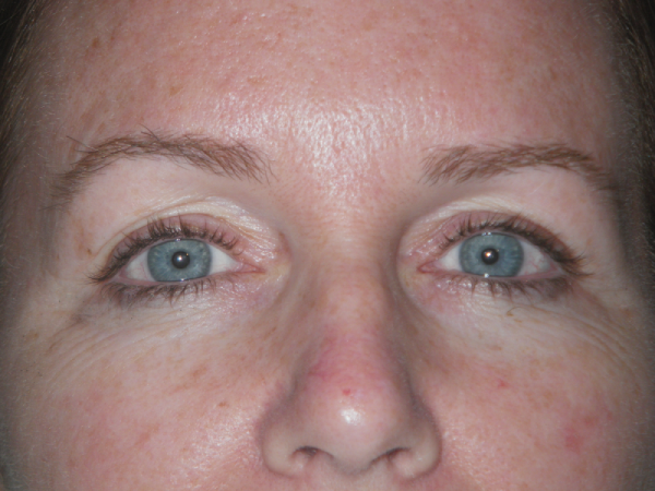 Before Photo of Eyeliner Treatment at MPi Clinic San Diego