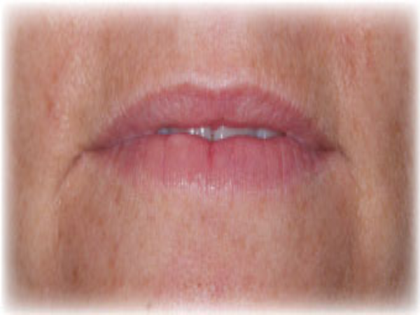 Before Photo of Lip Treatment at MPi Clinic San Diego