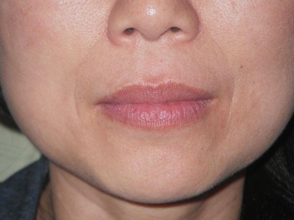 Before Photo of Lip Treatment at MPi Clinic San Diego