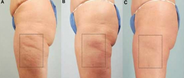 Cell Stimulation Treatment for Reducing Cellulite at MPi Clinic San Diego