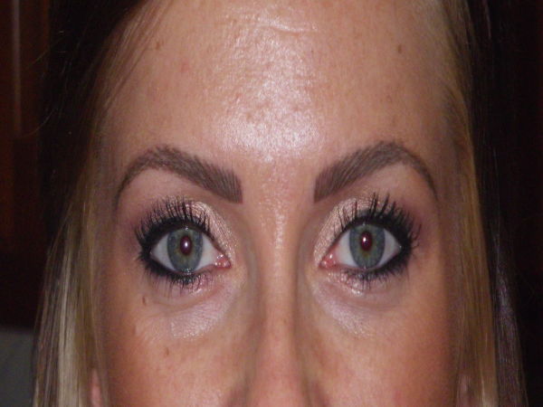 After Photo of Eyebrow Treatment at MPi Clinic San Diego