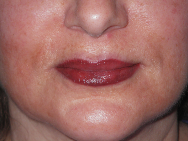 After Photo of Lip Treatment at MPi Clinic San Diego